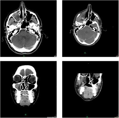 POR | The Role of Stereotactic Radiotherapy in the Management of ...