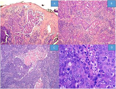 POR | Case report: Primary vulvar adenocarcinoma of mammary gland type ...